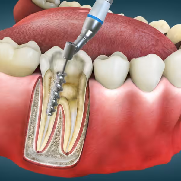 rotfyllning tandvärk infektion i tand